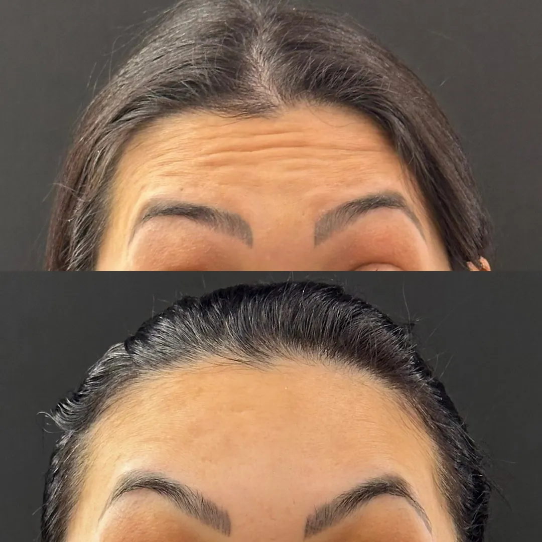 Antes e depois de toxina botulínica na testa — linhas horizontais suavizadas